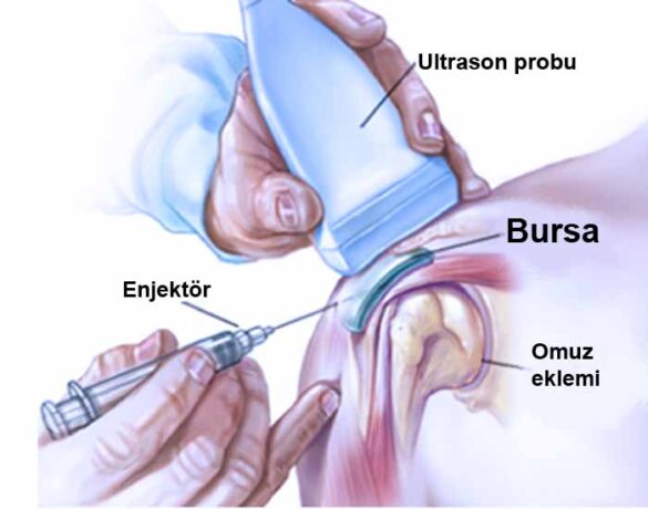 Bursit tedavisi ultrason eşliğinde enjeksiyon