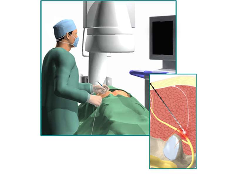 Medial branch nerve radiofrequency ablation in the procedure room